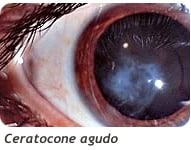 Ceratocone Agudo