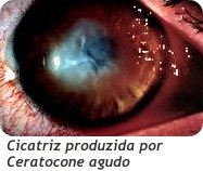 Ceratocone Agudo Cicatriz