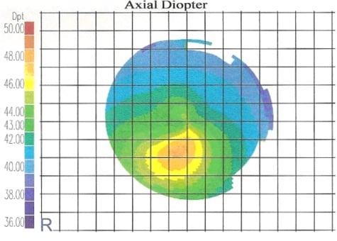 Ceratocone Topográfica Grau 2
