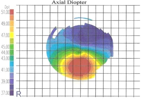 Ceratocone Topográfica Grau 3