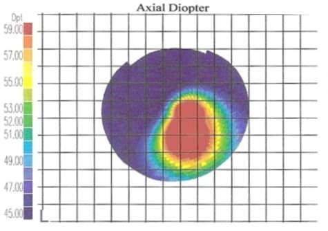 Ceratocone Topográfica Grau 4