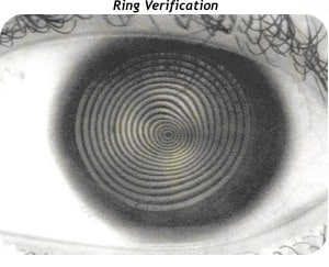 Ceratocone - Ring Verification
