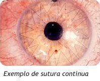 ceratoconeTratamento1