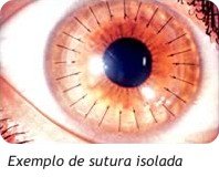 Ceratocone Tratamento - Exemplo de satura isolada