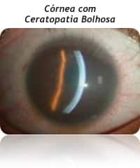 Ceratopatia Bolhosa