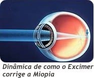 Cirurgia personalizada a Laser