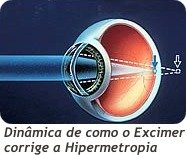 Cirurgia Laser Procedimento
