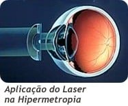 Cirurgia Laser Procedimento