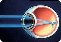 No olho míope a imagem é focalizada antes da retina, provocando uma visão desfocada para longe.