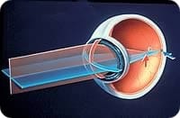 A forma mais frequente de astigmatismo é a provocada pela diferença de curvatura da córnea em diferentes raios, determinando dois pontos de foco na retina.