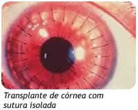 Transplante de córnea com sutura isolada
