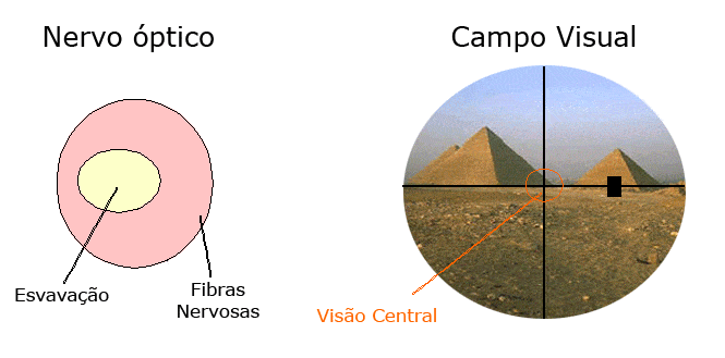 Esquema de escavação de nervo óptico e perda progressiva do campo visual
