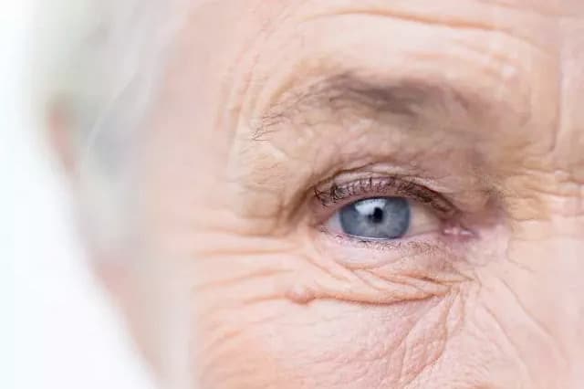 Glaucoma
